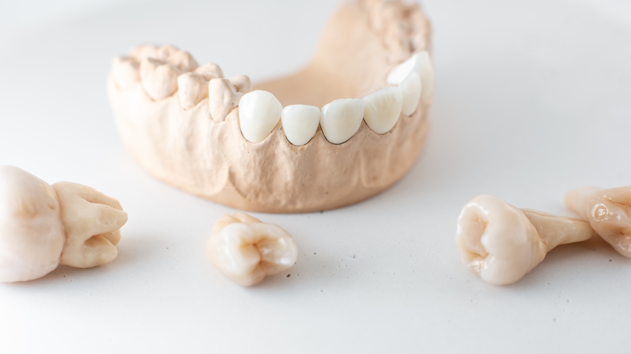 What Are Dental Crowns