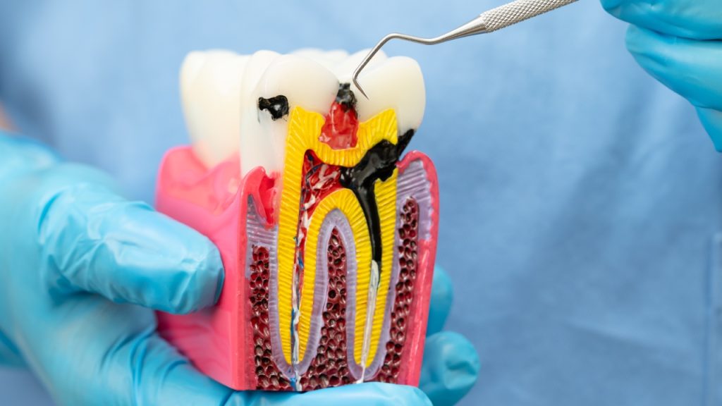 what is a root canal